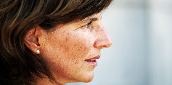 Frau im Profil mit Altersflecken im Gesicht